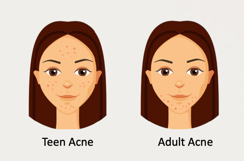 Top Causes of Acne in Adults & Teenagers | Complete Dermatology Guide - Dermatology blog by Dr. Kashif in Peshawar, Pakistan