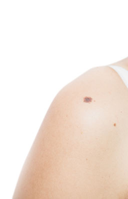 Moles & Skin Tags treatment in Peshawar, Pakistan - Dr Kashif's Aesthetic Studio