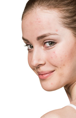 Acne Scars treatment in Peshawar, Pakistan - Dr Kashif's Aesthetic Studio