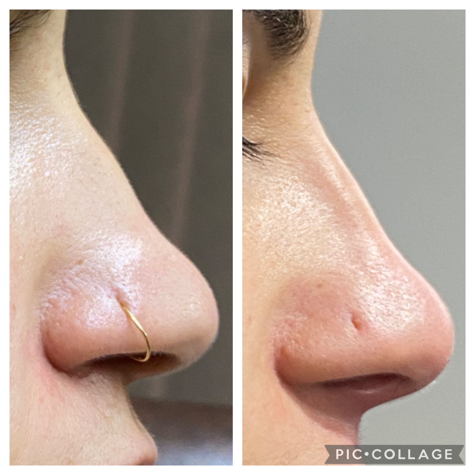 Non-Surgical Liquid Rhinoplasty treatment in Peshawar, Pakistan - Dr Kashif's Aesthetic Studio